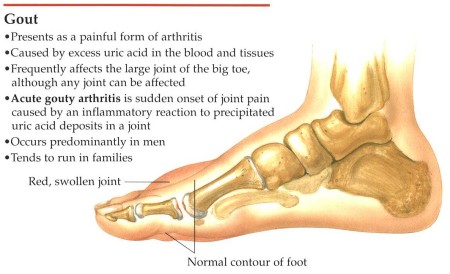 pictures of gout in the hand